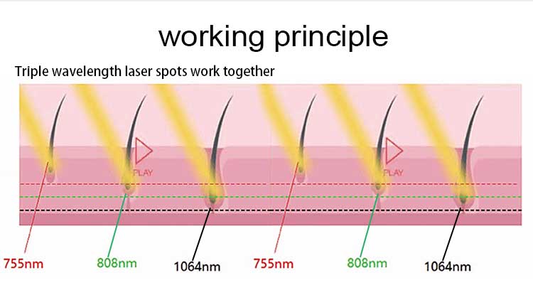 Alma 755nm 808nm 1064nm Diode Laser Alma Soprano ICE Triple Wavelength Diode Laser Alma Hair Removal Machine Device