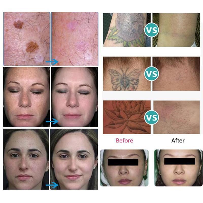 High Quality Nd Yag Laser 755 1320 1064 532nm Picosecond Laser Tattoo Removal Machine Face Skin Care Tools