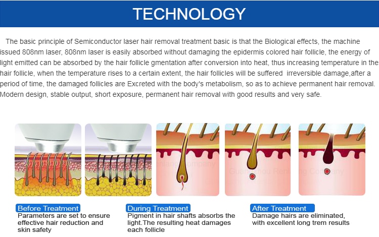 Diode Laser 755 808 1064nm Multi Wavelengths Hair Removal Machine Cooling Head Painless Laser Epilator Face Body Hair Removal