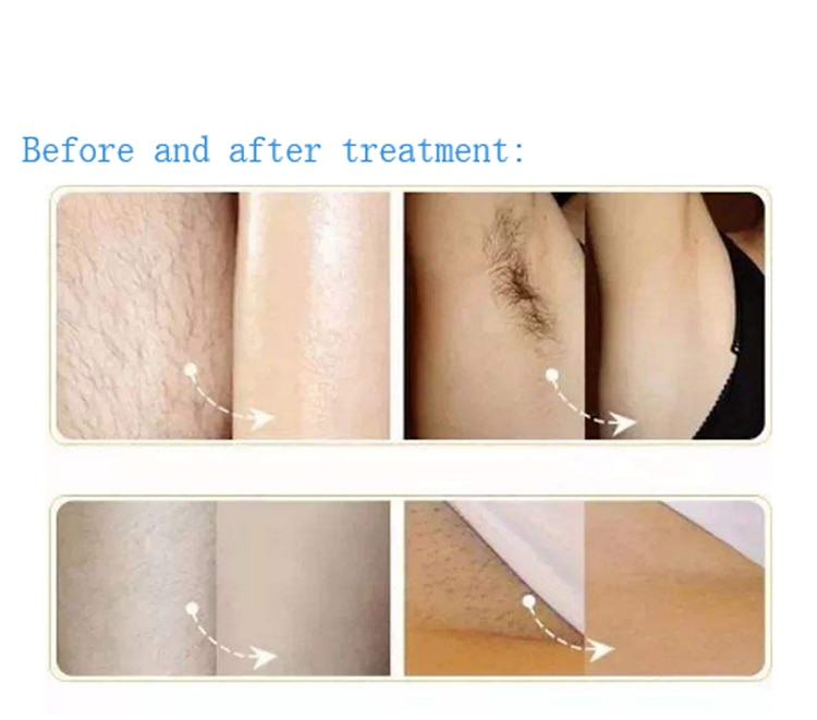 IPL OPT SHR Laser Hair Removal Machine Professional Skin Care Rejuvenation Equipment Language Customization For Permanent Use