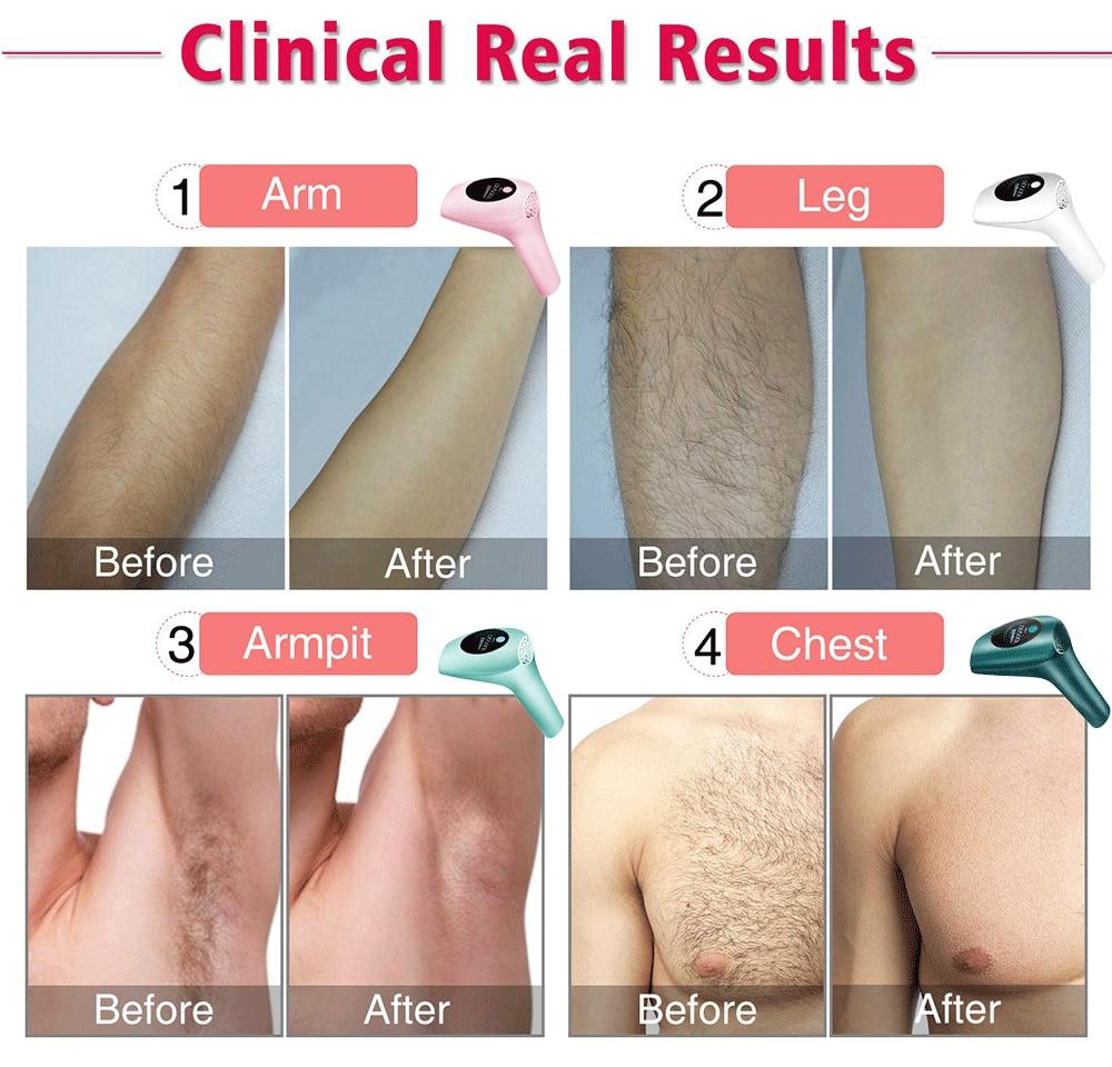 KODO 900000Flashes Laser Epilator Laser Hot Sell Permanent IPL Photoepilator Hair Removal Painless Electric Epilator Machine