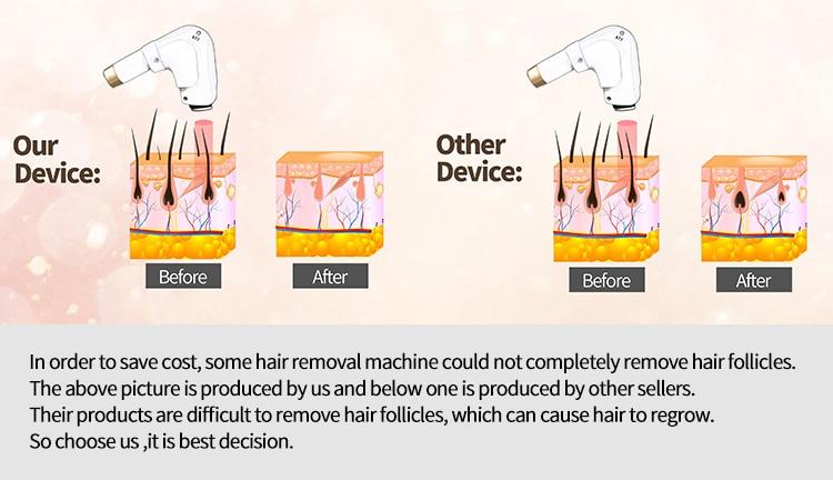 Ice Titanium Soprano Instrument Painless Permanent Epilator 755 808 1064nm Triple Wavelength Diode Laser Hair Removal Machine