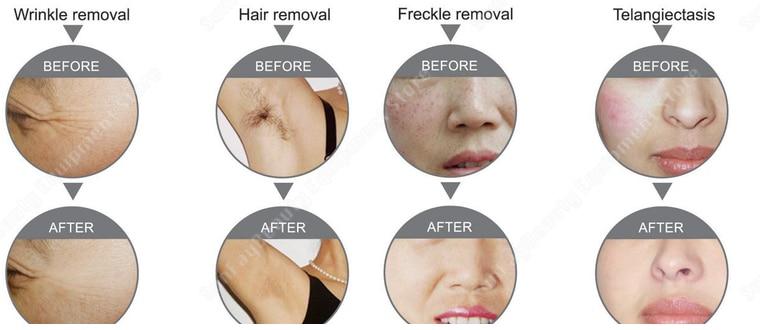 OPT/IPL Laser E-Light Permanent Hair Removal Machine Double Screen 1064nm 532nm 1320nm NG-YAG Tattoo Removal With Carbon Peeling