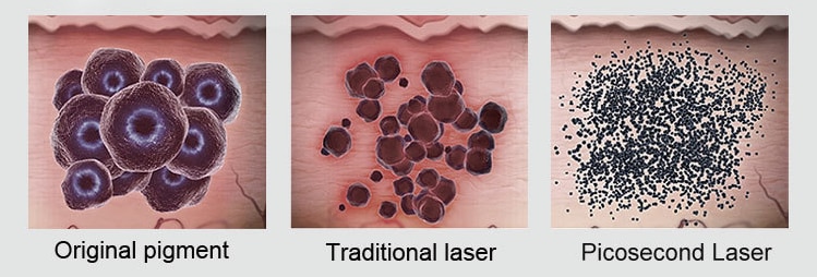B&M Q Switch ND YAG Laser price/ Tattoo Removal machine 1064 532 1320 tattoo removal