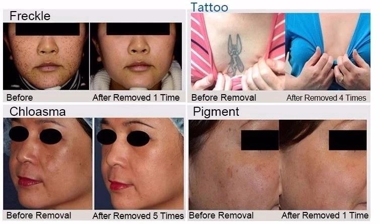 Latest styles 360 Magneto Opt +SHR+IPL+E-light + Nd Yag Laser + RF for Hair Removal + Skin Lift +1064nm Tattoo Beauty Machine