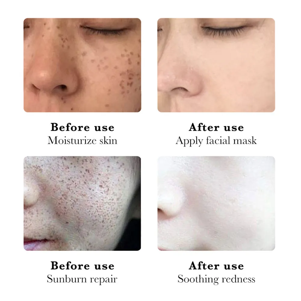 Nicotinamide Whitening Freckles Cream Remove Melasma Dark Spot Acne Marks Lightening Melanin Brightens Skin Tone Face Skin Care