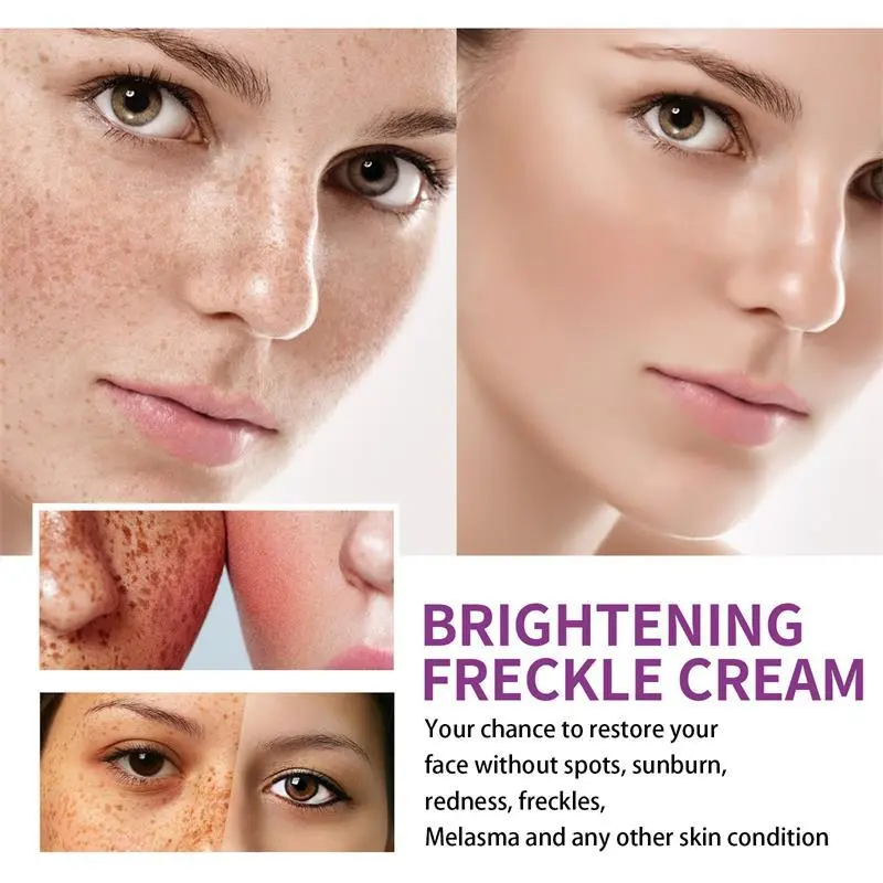 Nicotinamide Whitening Freckle Removing Cream Effectively Remove Melasma Dark Spot Acne Marks Lightening Melanin Face Skin Care