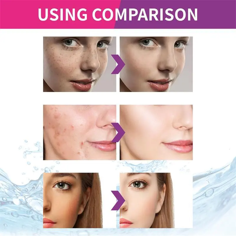 Nicotinamide Whitening Freckle Removing Cream Effectively Remove Melasma Dark Spot Acne Marks Lightening Melanin Face Skin Care